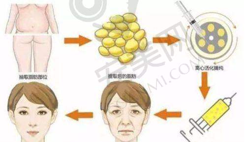 如何选择适合自己的小阴唇整形方案？