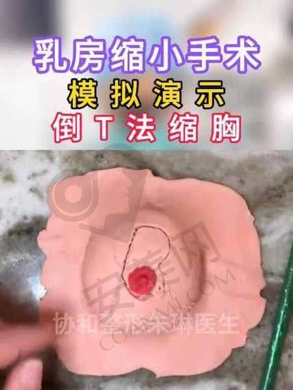 重庆松山医院巨乳缩小项目怎么样？