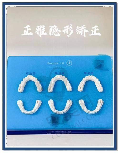 正雅隐形矫正有哪些特点？