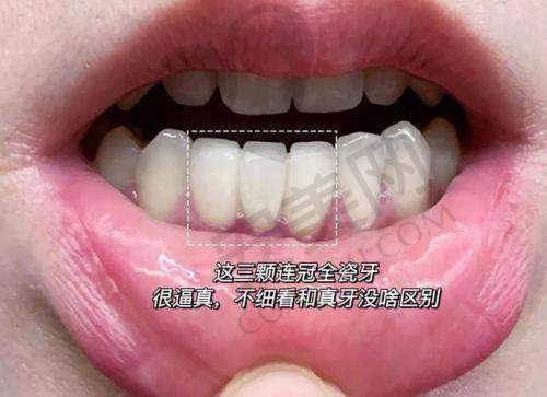 1800元起的国产全瓷牙冠有哪些品牌和型号可供选择？