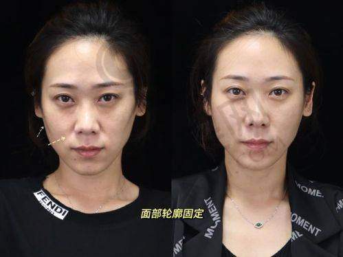 北京联合丽格面部轮廓整形有哪些成功实例？