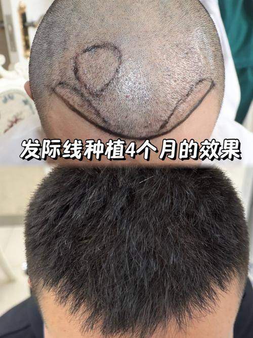 北京中德毛发移植医院种植发际线的技术特色是什么？