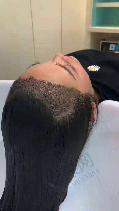 种植发际线手术过程是怎样的？