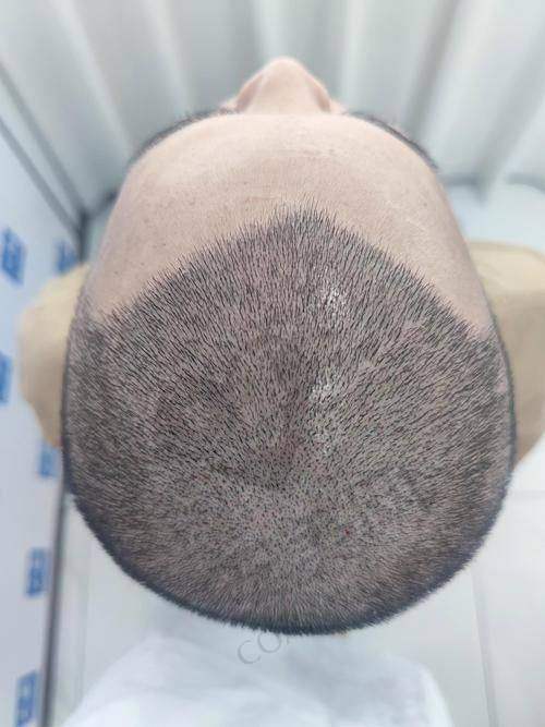 种植发际线后对我的生活有什么改变？