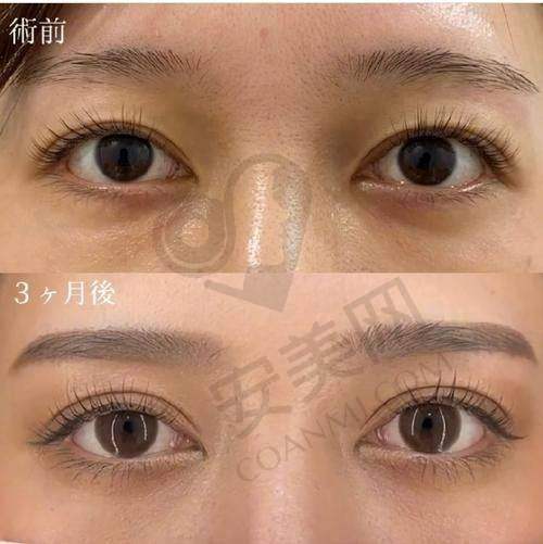 如何选择适合自己的埋线双眼皮方案？