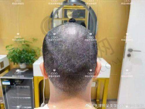 北京中德植发医院的患者评价如何提升其有名度？
