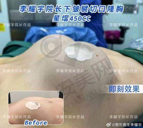 武汉同济医学院医院假体隆胸技术有什么特色？