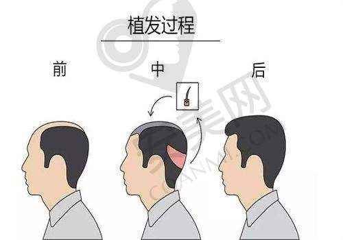 成都大麦植发的医生团队如何保护PSE微针精细种植的成效？