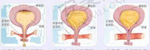 脂肪隆胸手术的过程是怎样的？