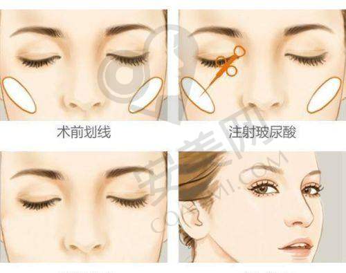 广州艺星和美莱的价格体系谁更合理？