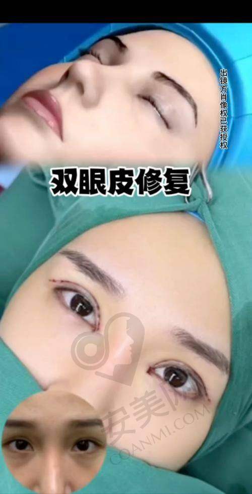 北京晶美双眼皮疤痕修复技术特色在哪？