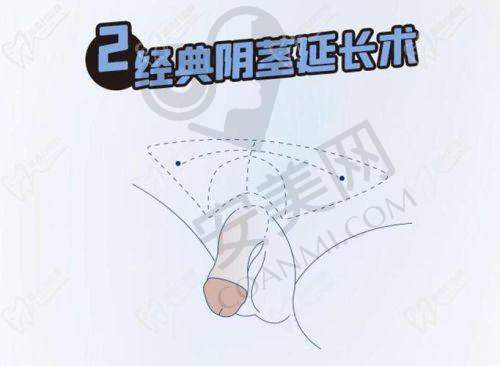 3、广州建国王文卫医生整形技术怎么样？
