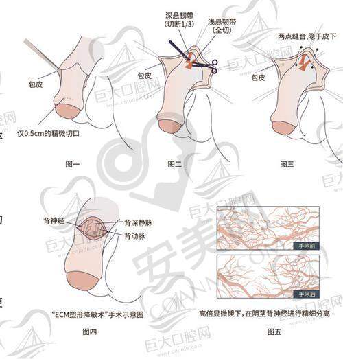 广州建国生殖健康医院阴茎增粗手术的技术特色是什么？