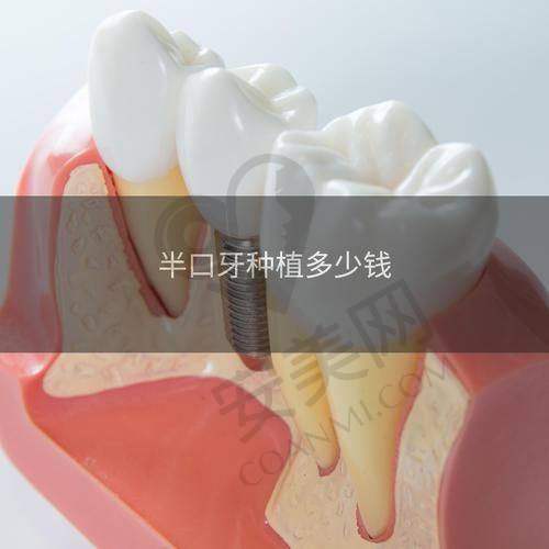 如何选择适合自己的 all - on - 4 半口种植牙方案