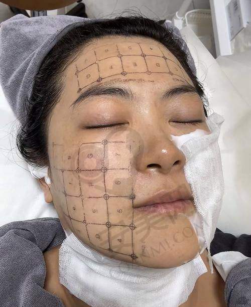 石家庄美莱石娟娟热玛吉6800元起的价格优势在哪里？