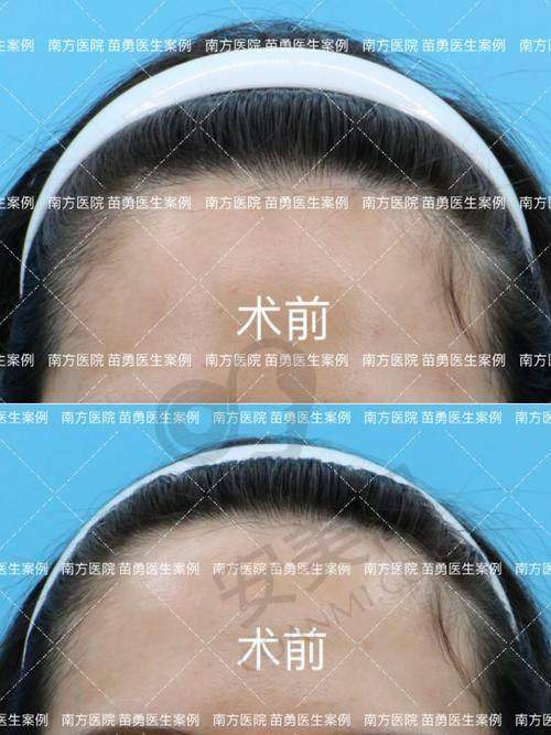 选择成都大麦植发PSE微针精细种植能带来怎样的改变？
