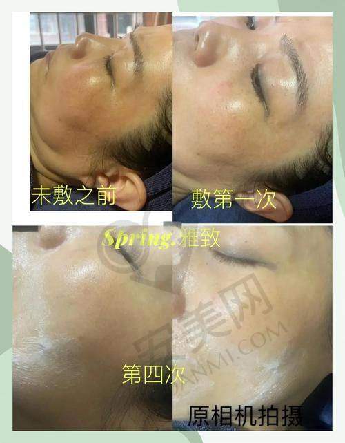 中山禾佳超声炮嫩肤的治疗过程是怎样的？