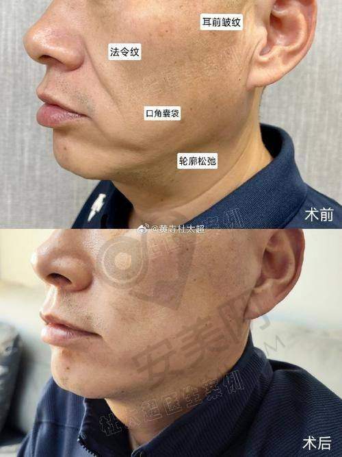 神奇体验：小切口口内提升的惊艳成效
