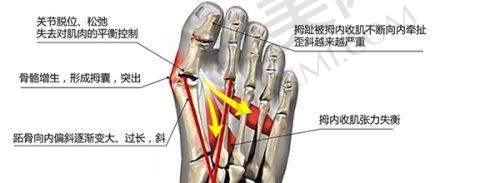 什么是超声炮抗衰？