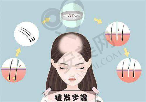 郑州华仁植发刘裴华医生患者评价