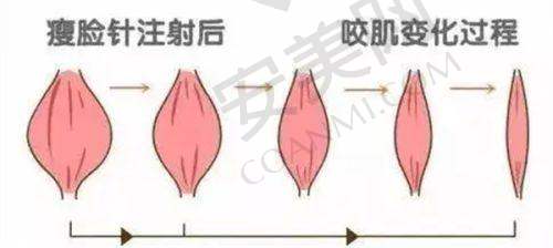 2980元起的瘦脸针，性价比如何？