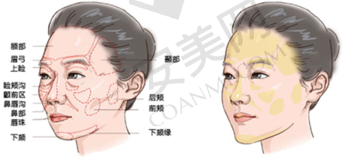 微针注射是什么？有什么特色？