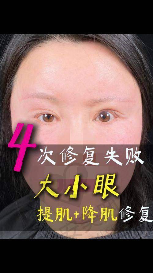 蔡昌琪医生在双眼皮修复领域有何独特之处？