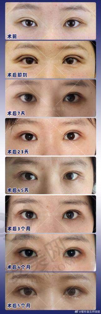 张圆圆医生双眼皮修复的预约挂号方式