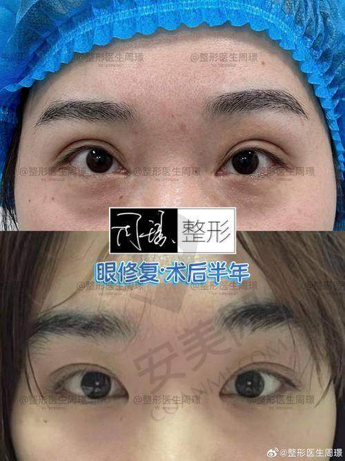 修复手术的过程可怕吗？