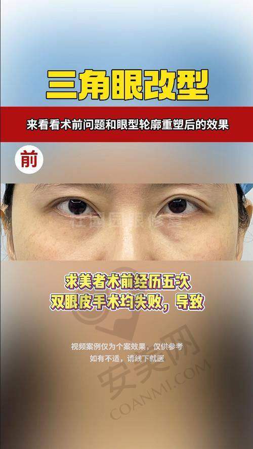 张圆圆医生双眼皮修复的价格