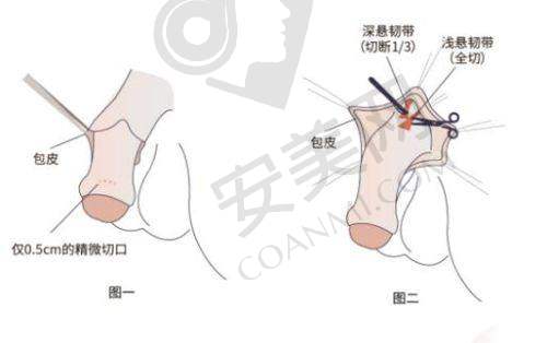 增粗手术的过程是怎样的？