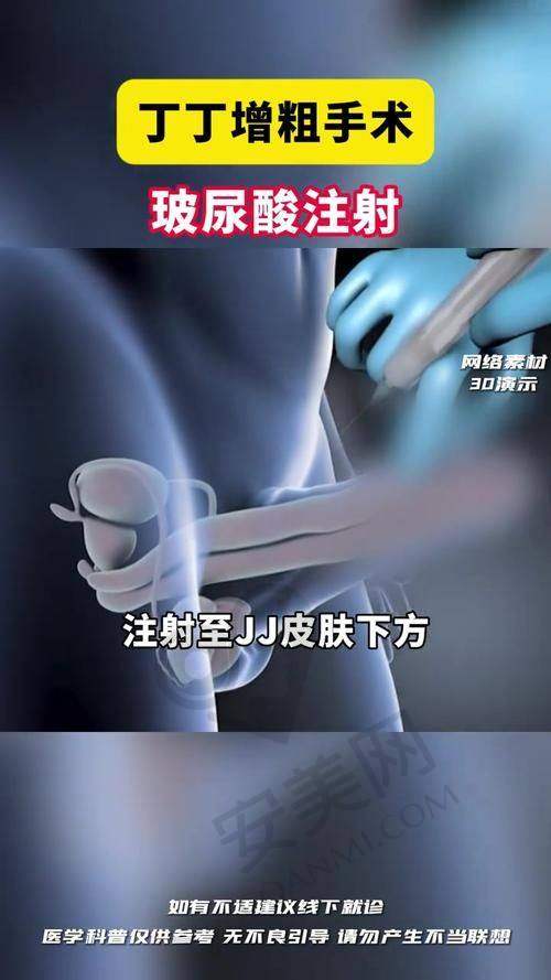 增粗手术19800元起的优势在哪里？
