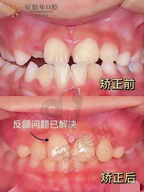 影响地包天矫正费用的因素