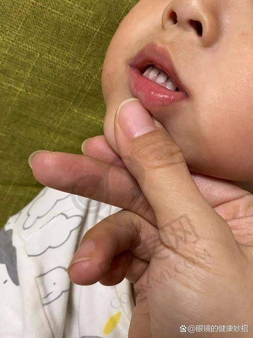 不同人群地包天矫正费用特点