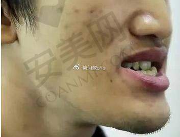 为什么选择安阳植得口腔医院进行地包天矫正？