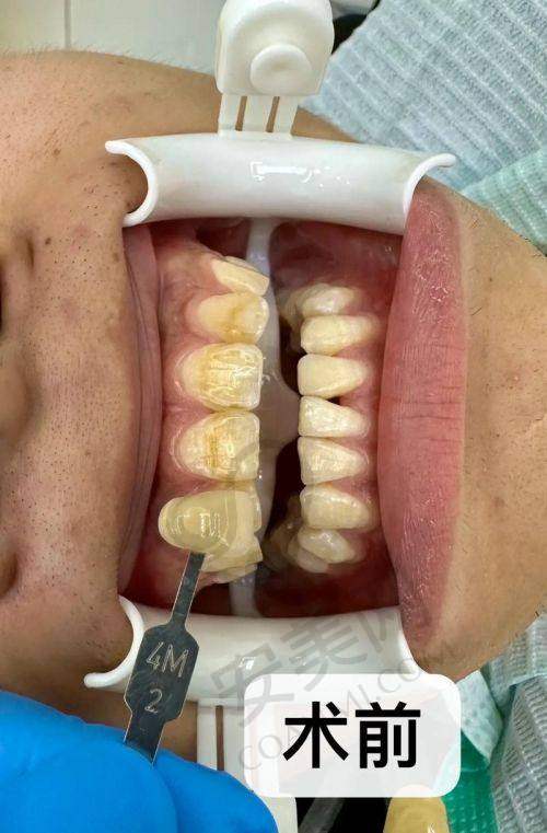 牙齿美白的具体过程是怎样的？