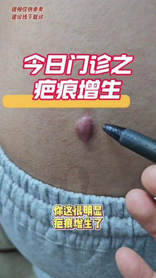 成都军建医院修复增生疤痕采用了什么技术？