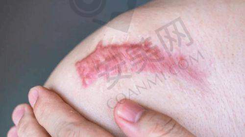 治疗过程中的感受如何？