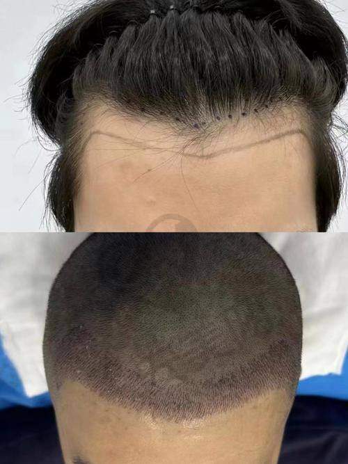 郑州华仁植发医院的专精团队如何？