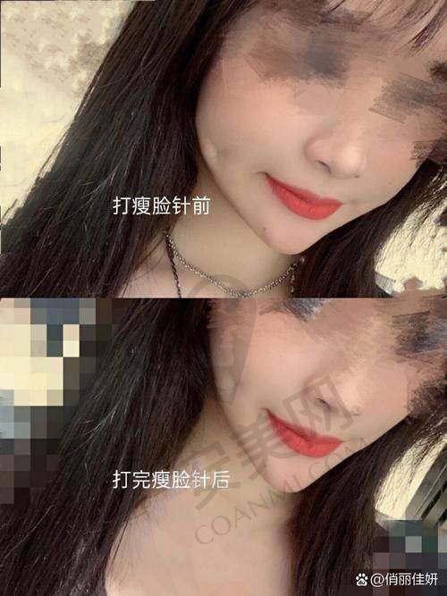 瘦脸针的安心性如何保护？