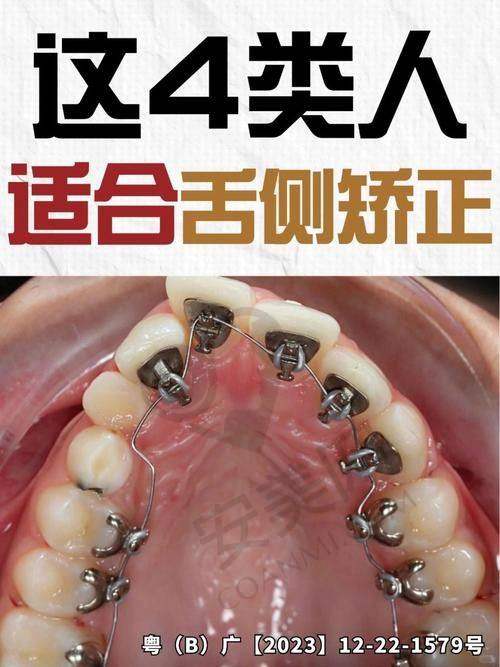 患者实例：见证舌侧矫正的神奇成效