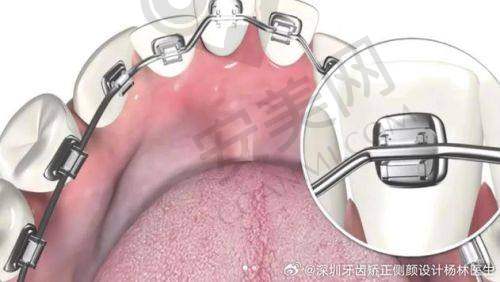 46800元起的舌侧矫正价格：性价比之选