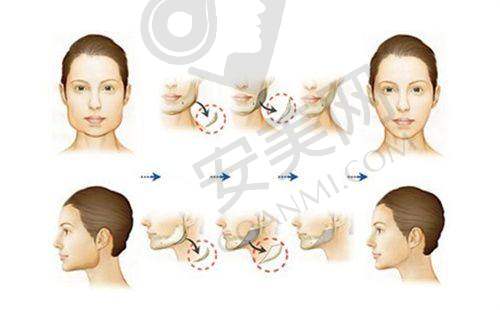 24小时急速丰胸技术有什么优势？