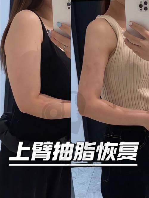 阳海斌医生：手臂吸脂的骨干医生