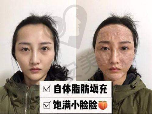 郑州做脂肪填充多少钱