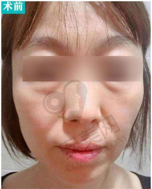 术后成效：自然美观，持久显著