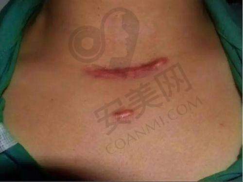 苏州乐桥疤痕研究院的治疗成效如何？