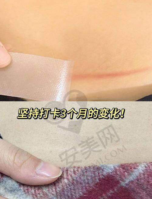 苏州乐桥疤痕研究院有哪些精良的治疗技术？