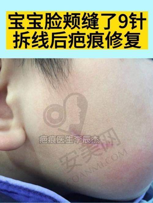 苏州乐桥疤痕研究院的口碑怎么样？