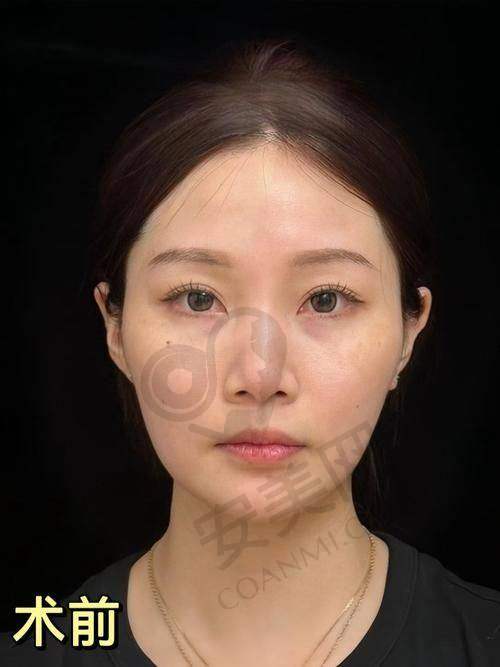 玻尿酸注射项目有什么特色？